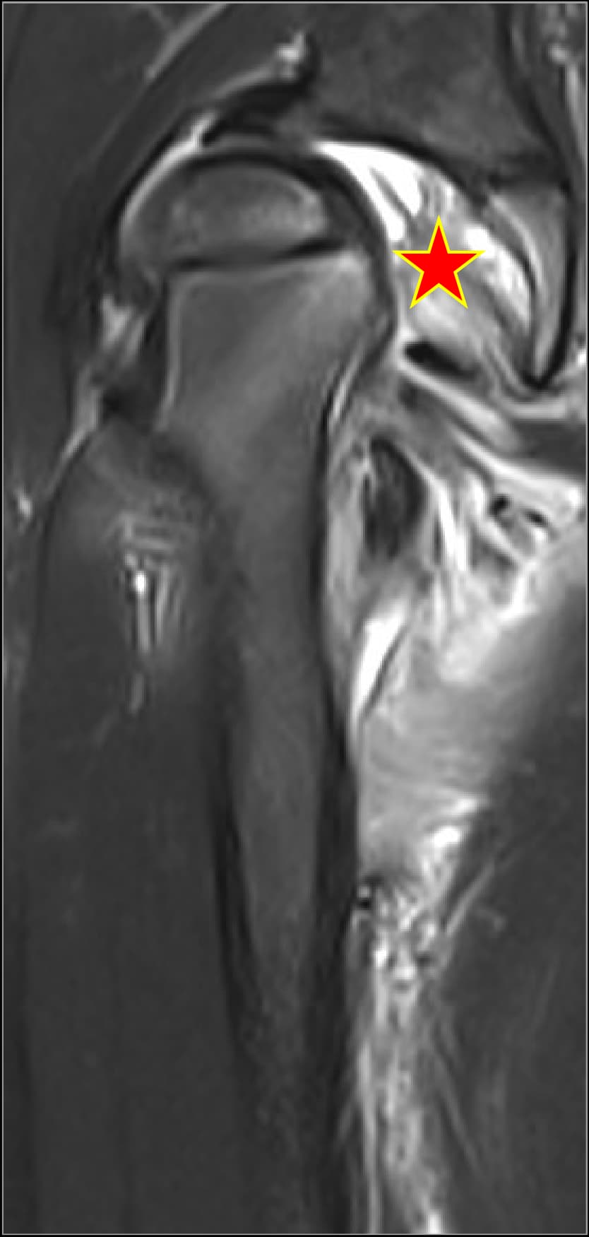 Septic Hip Arthritis