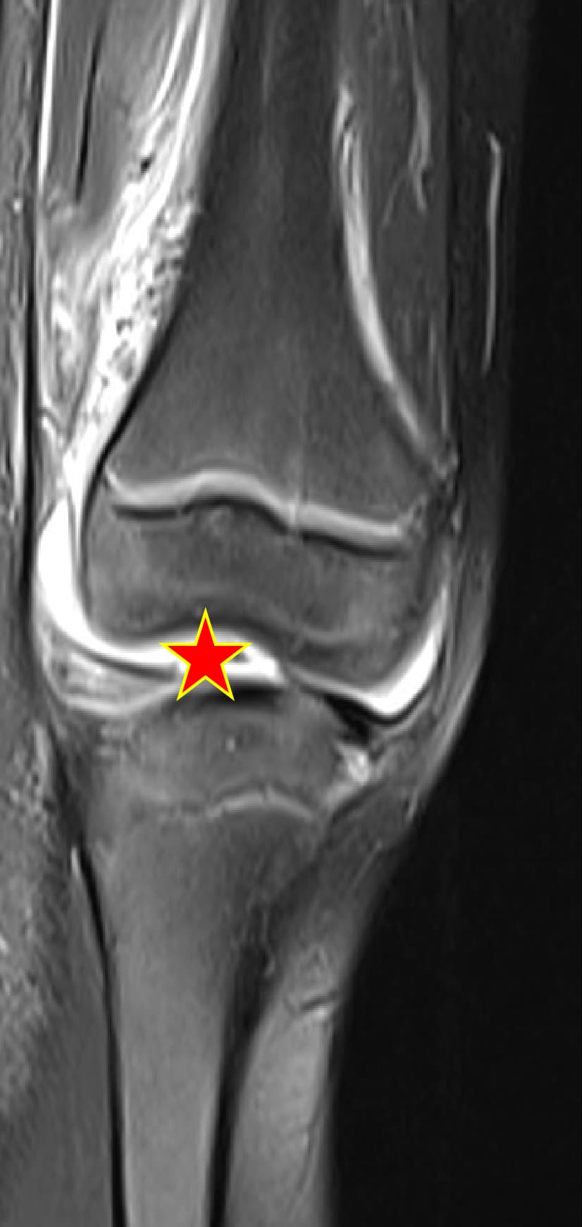 Septic Knee Arthritis