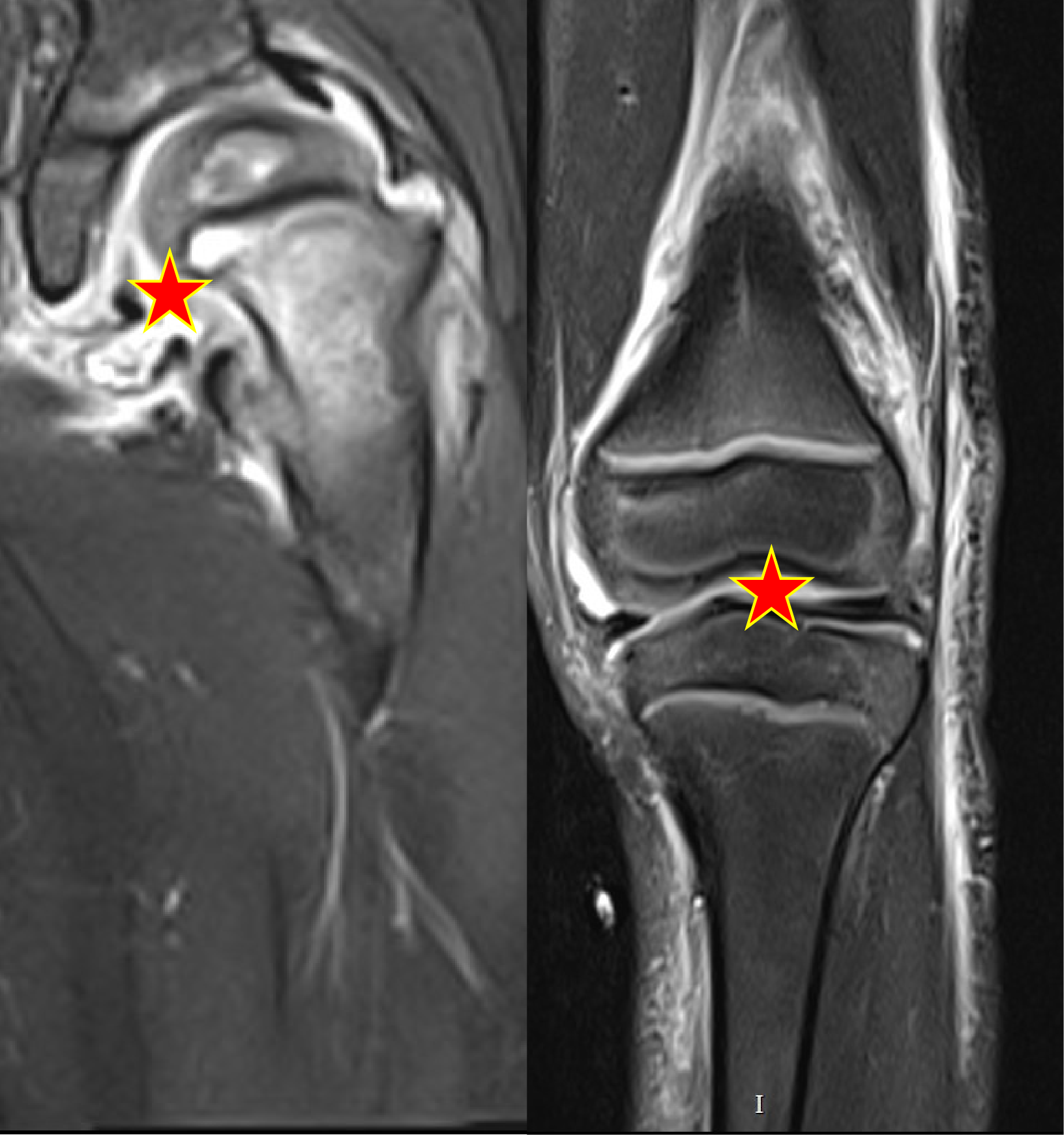 Septic hip arthritis or Septic knee arthritis