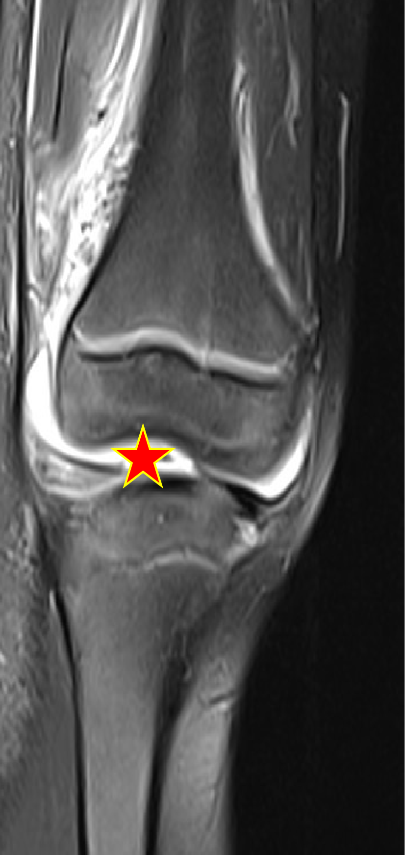 Septic knee arthritis